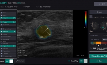 Breast Ultrasound AI